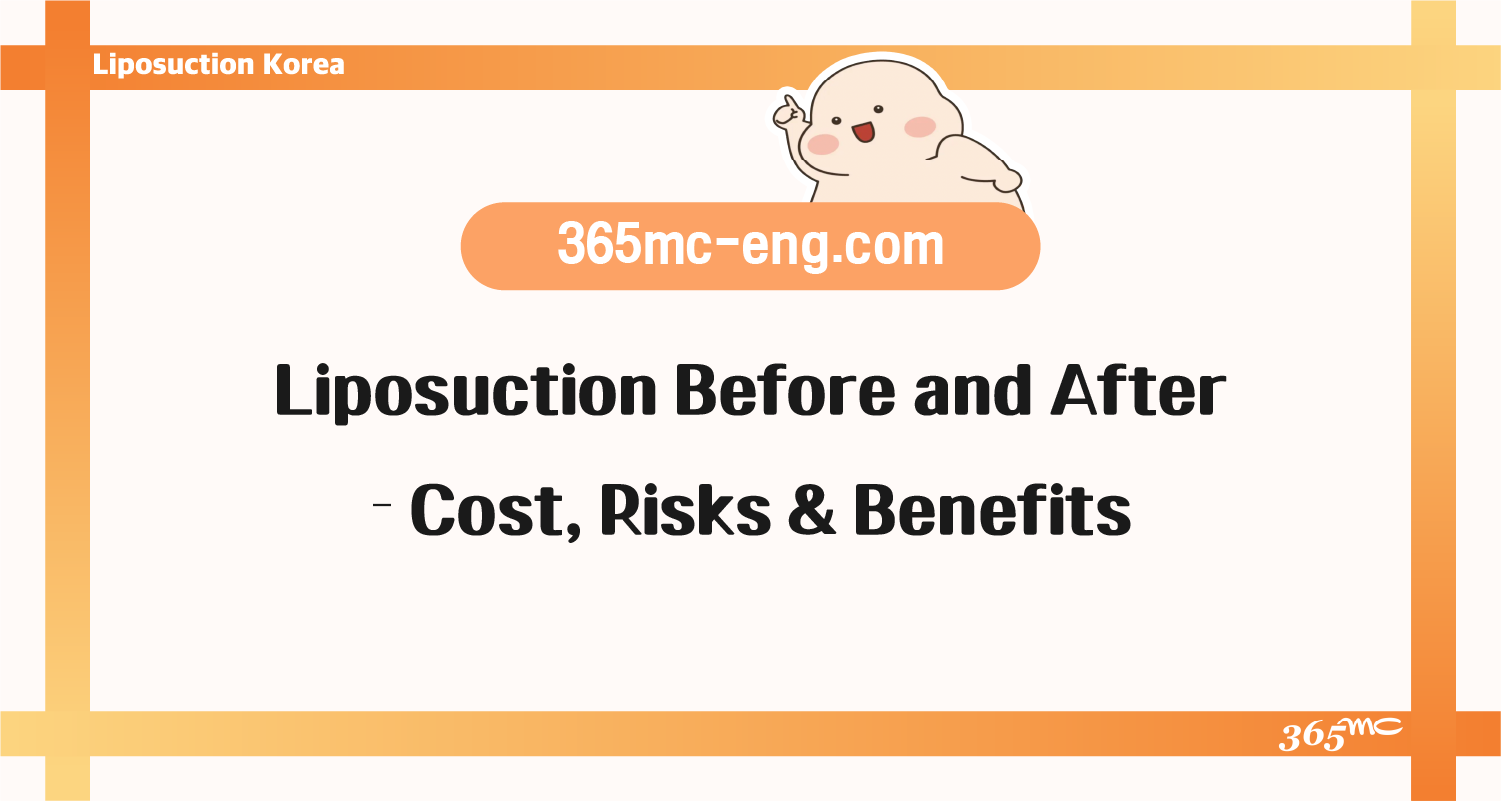 Thigh Liposuction Korea: Obesity Fatness Recovery, Cost and Benefits -  365mc Hospital